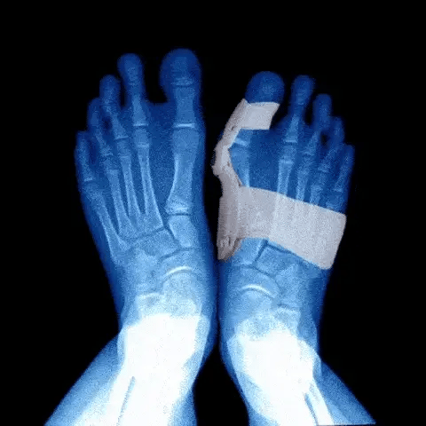 Corrector De Juanete Ferula Graduable